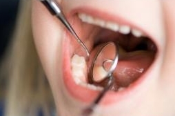 Герметизация фиссур одного зуба