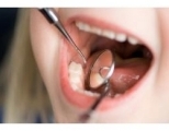 Герметизация фиссур одного зуба