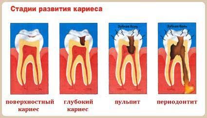 Лечение периодонтита