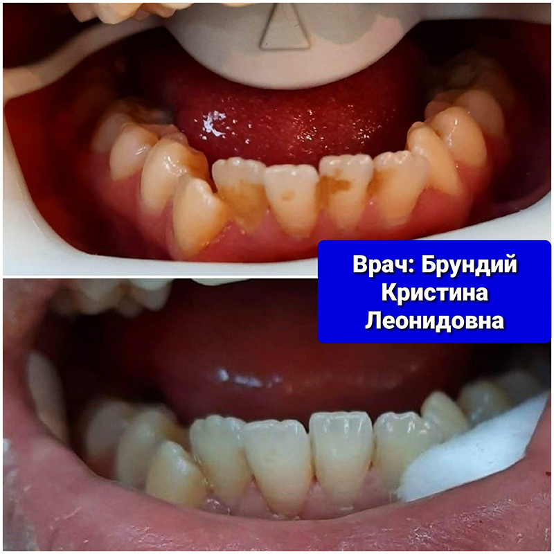 Эстетическая реставрация