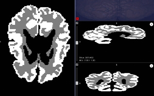 Белорусские врачи смогут точнее выявлять ДЦП у новорожденных с помощью нейросети Яндекса